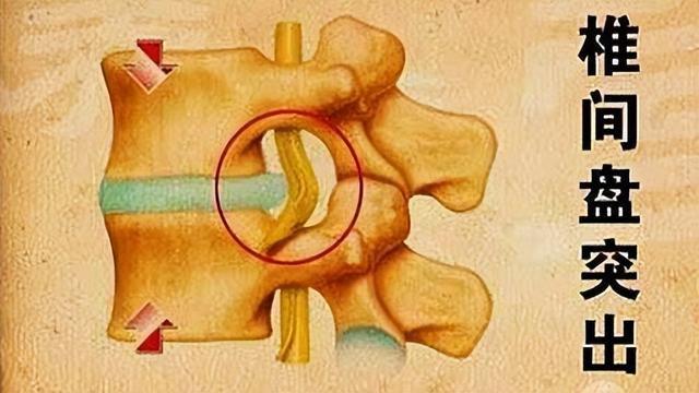 腰椎间盘突出最新疗法，探索与突破的成果分享