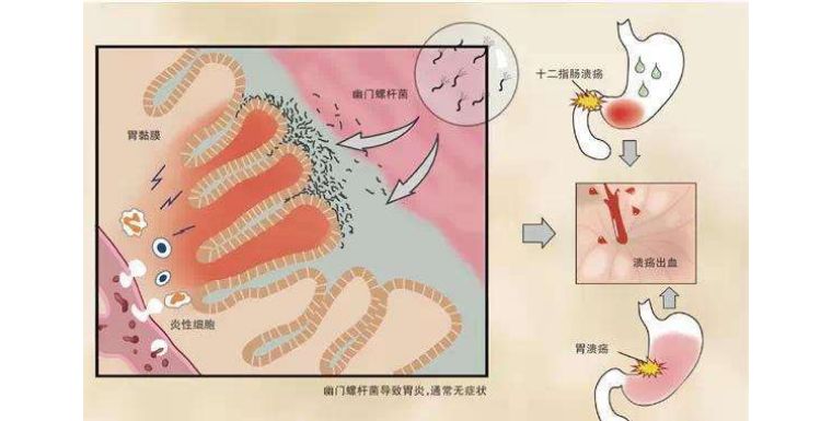 四联疗法治疗幽门螺杆菌，开启健康新篇章