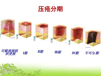 压疮最新研究及治疗进展综述